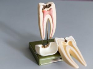 the difference between a cavity and needing a root canal